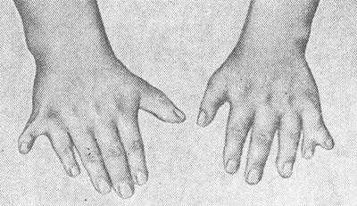 Рис. 1. Шестипалые кисти больного с синдромом Лоренса—Муна—Бидля.