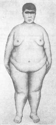 Рис. 2. Больной e синдромом Лоренса—Муна—Бидля: резкое ожирение с гинекомастией.