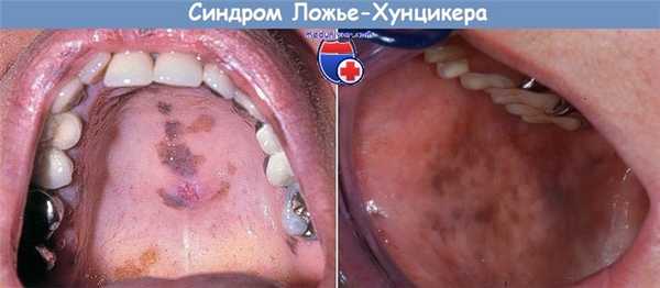 Синдром Ложье-Хунцикера