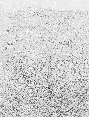 Рис. 2. Микропрепарат коры головного мозга при болезни Пика: резкое уменьшение числа клеток в верхних (II, IIIа) слоях коры головного мозга; окраска по Нисслго; х 18.