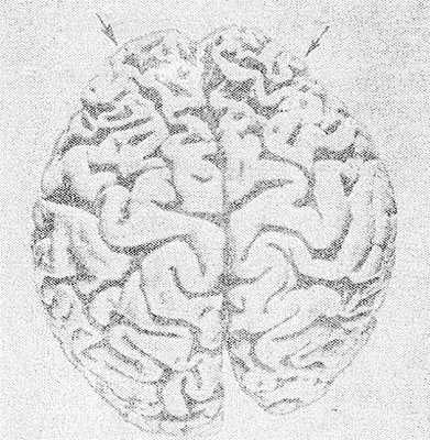 Рис. 1. Макропрепарат головного мозга при болезни Пика: выраженная атрофия извилин коры лобных долей (указано стрелками) и уменьшение размеров правого полушария головного мозга.