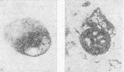 Рис. 3. Микропрепараты коры головного мозга при болезни Пика: а — баллоновидная нервная клетка с центральным хроматолизом и эктопией ядра; окраска по Нисслю; Х400; б — шаровидное аргентофильное включение (тельце Пика, указано стрелкой) в цитоплазме нервной клетки; импрегнация по Билыиовскому; х400.
