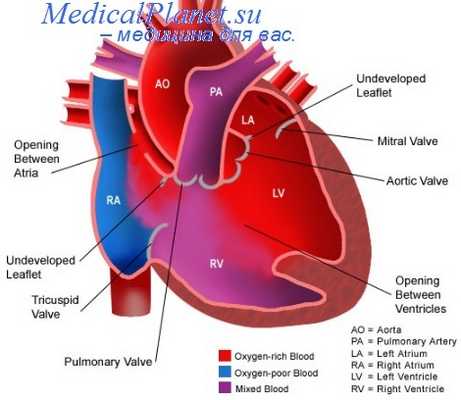 дефект межпредсердной перегородки