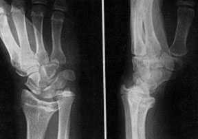 Рентгенограмма кисти с деформацией Маделунга