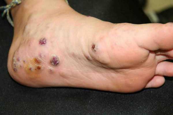 синдром маффуччи фото