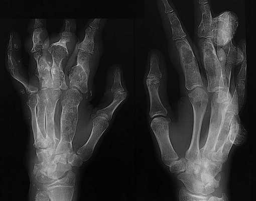 синдром маффуччи