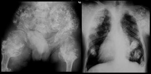 синдром маффуччи множественные гемангиомы