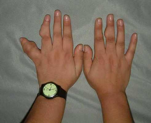 синдром маффуччи частота встречаемости 