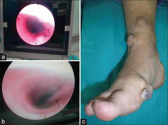 синдром маффуччи болезнь олье