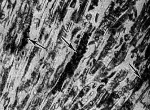 Болезнь Мак-Ардла (гликогеноз V типа)