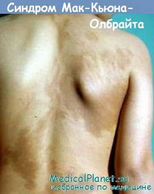 синдром Мак-Кьюна-Олбрайта