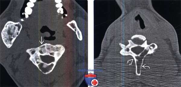 КТ при фиброзной дисплазии позвоночника (синдроме МакКьюна-Олбрайта)