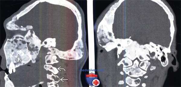 КТ при фиброзной дисплазии позвоночника (синдроме МакКьюна-Олбрайта)