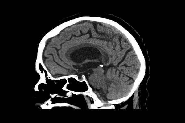 Болезнь Маркиафавы-биньями