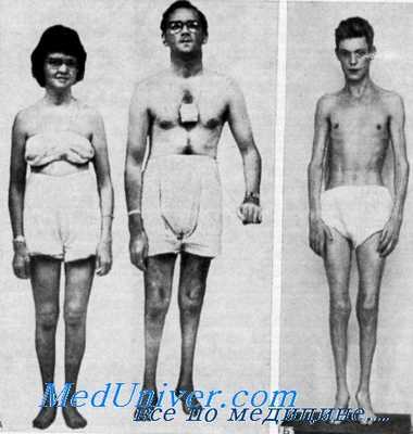 синдром рефсума