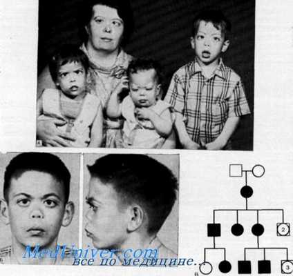 синдром маршалла