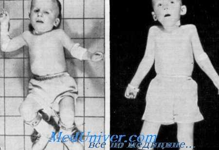 глухота со слабоумием