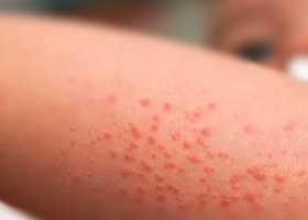 Тромбоцитопеническая пурпура