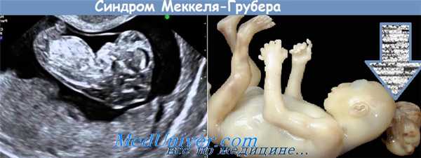 Синдром Меккеля