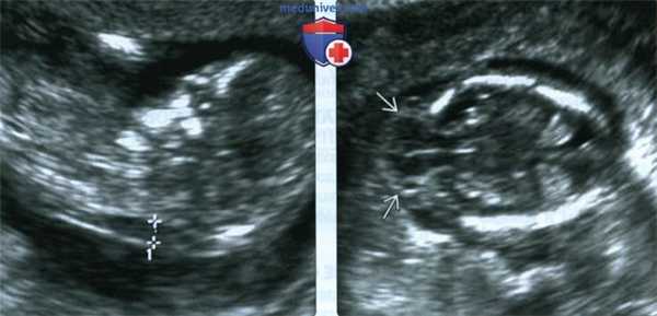 УЗИ, МРТ при синдроме Меккеля-Грубера у плода