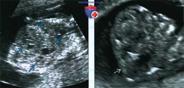 УЗИ, МРТ при синдроме Меккеля-Грубера у плода