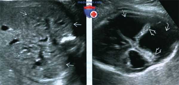 УЗИ, МРТ при синдроме Меккеля-Грубера у плода