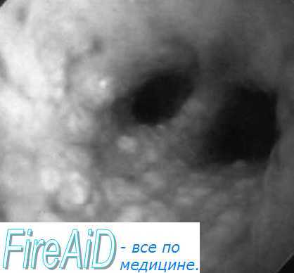 Аспирационный пневмонит (синдром Мендельсона). Этиология ( причины ), патогенез пневмонита ( синдрома Мендельсона ).