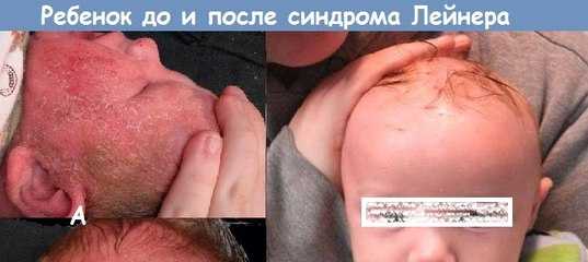 Синдром Лейнера (Leiner) - синонимы, авторы, клиника