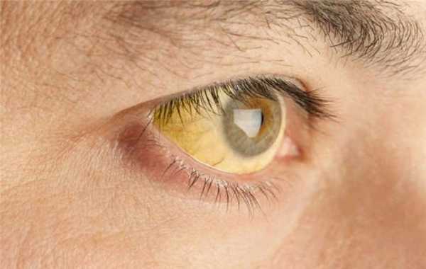 Изображение к статье о синдроме Жильбера и других пигментных гепатозах, медицинская энциклопедия resursor.ru