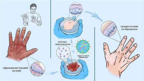 Буллезный эпидермолиз.jpg
