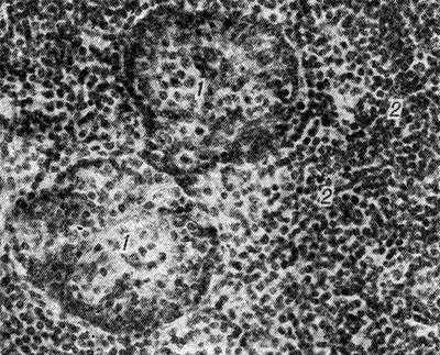 Микропрепарат слюнной железы при синдроме Микулича: миоэпителиальные островки (1) и инфильтрация (2) межуточной ткани лимфоидными клетками.