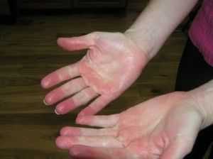 Эритромелалгия конечностей