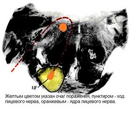 Синдром Мийяра-Гюблера