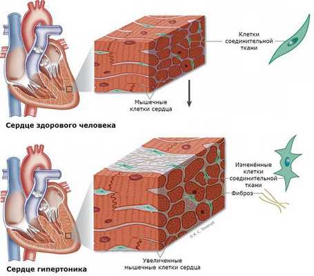 Синдром Иценко-Кушинга (гиперкортицизм)