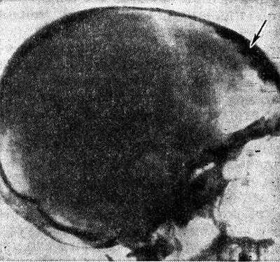Рентгенограмма черепа (боковая проекция) больного с синдромом Морганьи: резкое утолщение лобной кости (указано стрелкой) за счет гиперостоза внутренней пластинки.