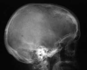 Педжета болезнь_череп_боковая проекция