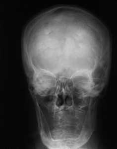 Педжета болезнь_череп_прямая проекция