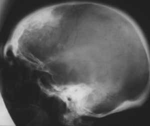 Морганьи-Стюарта-Мореля синдром_гиперостозы1