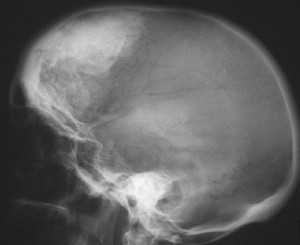 Морганьи-Стюарта-Мореля синдром_гиперостозы2