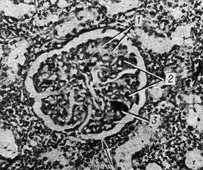 Рис. 2. Микропрепарат почки при болезни Мошкович: почечный клубочек (указан стрелкой) с участками фибриноидного некроза (1), окклюзией просветов капиллярных петель (2) эозинофильными массами и скоплением гематоксилинофильных ложноизвестковых зерен (3); окраска гематоксилин-эозином, X 200.