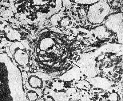 Рис. 1. Микропрепарат почки при болезни Мошкович: стрелкой указано фибриноидное набухание и плазматическое пропитывание стенки мелкой артерии; окраска гематоксилин-эозином, х 200.