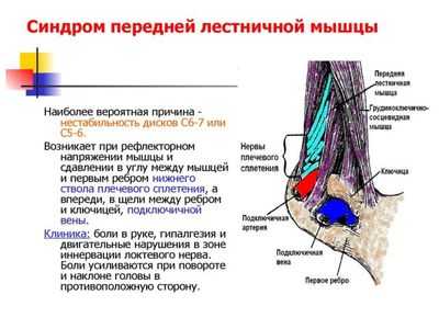 синдром Наффцигера