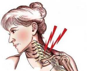 скаленус синдром