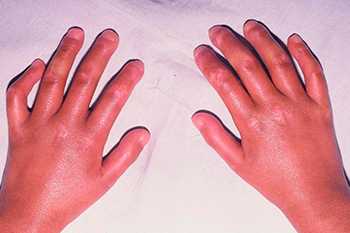 синдром Шарпа