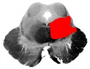 Синдром Нильсена (срез)