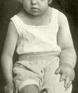 Нонне-Милроя лимфедема_девочка 5 лет