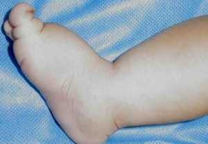 Нонне-Милроя-Мейжа лимфедема_нижняя конечность новорождённого