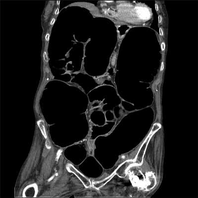 Синдром Огилви