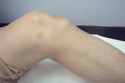 Болезнь Шляттера призанки