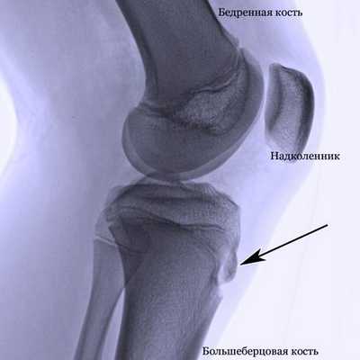 Рентген снимок колена